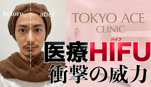 【衝撃】医療HIFU(ハイフ)すごすぎた【TOKYO ACE CLINIC】