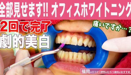 歯医者のオフィスホワイトニングの様子を全部見せます【福岡】圧倒的な変化でたった2回で劇的美白✨【博多の口コミで評判の歯科医がおすすめ】