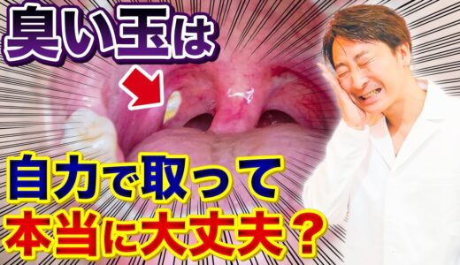 【口臭】臭い玉の対処方法【膿栓除去/扁桃腺】tonsillolith, tonsil stones #shorts