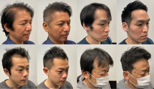 【はげ薄毛】薄毛が目立たない理想のヘアスタイルに大変身！