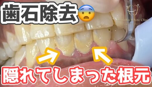 【閲覧注意】はじめての歯石除去😱歯の根元が歯石で隠れて見えません！ Tartar removal