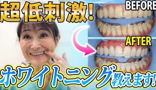 【歯医者】痛みが少ない最強ホワイトニング！歯を真っ白に変える方法を教えます