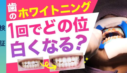 【歯科のホワイトニング】1回でどのくらい白くなる？痛い？オフィスホワイトニング＊検証＊