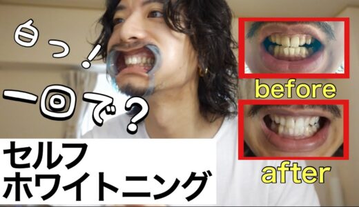【セルフホワイトニング】歯が白くなる、一回¥3960のビフォーアフターが凄すぎる！！