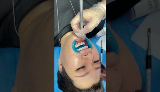 歯を掃除する歯科医 ::: 歯のホワイトニング ::: 歯のクリーニング歯石の除去  #shorts