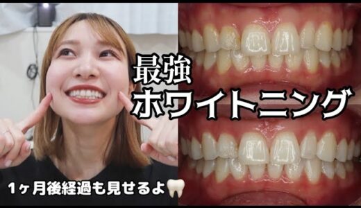 【激変】歯医者さんのホワイトニングって効果どうなの？痛みや経過、施術の様子🦷