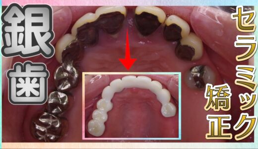【銀歯を白くしたい→セラミック矯正で改善】銀歯を白くして若返り・清潔感UP！柿野の症例解説【湘南美容クリニック仙台院歯科】
