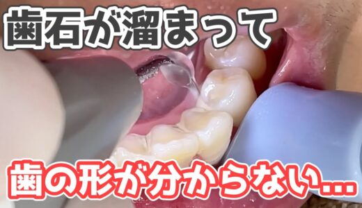 【閲覧注意】歯石が溜まって歯の形がわからない😱‼️歯石除去して綺麗に✨ Tartar removal