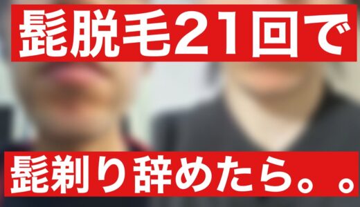 髭脱毛の厳しい現実をお伝えします