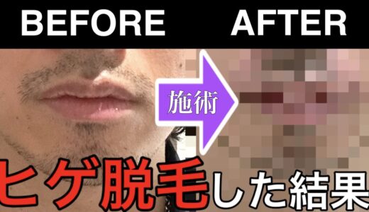 【閲覧注意】ヒゲ脱毛した結果！メンズTBCでまさかの24万円契約！？