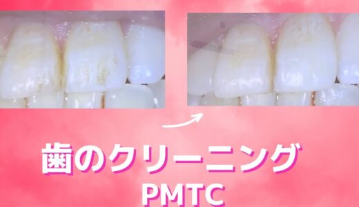 PMTC 白い歯に🦷✨