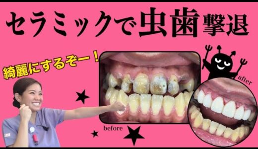 【深刻虫歯も】セラミックならこんなに綺麗に！【歯がほぼ見えなくても】