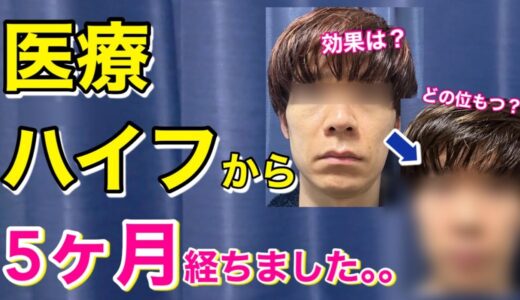 アラフォー男がたるみ治療してから5ヵ月経ったのでリアルな効果をお伝えします