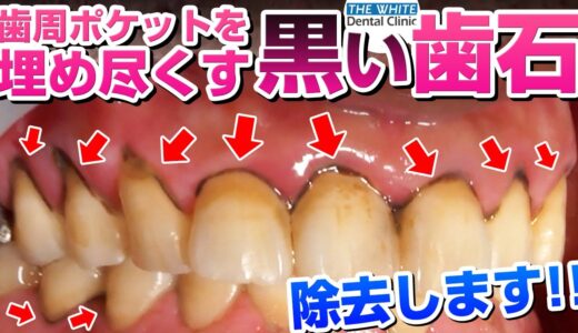 【歯石】歯周ポケットを埋め尽くす黒い歯石を除去します❗