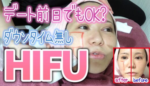 【ハイフ】好きな男に会う前日は１ミリでも顔のたるみを引き上げたい【顔のたるみと法令線との終わりなき戦い】