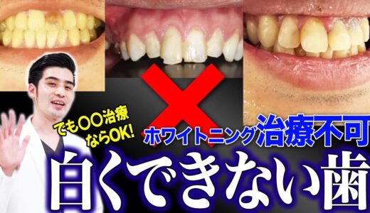 実はそれホワイトニングで白くできない歯かも？！治療方法まで解説！