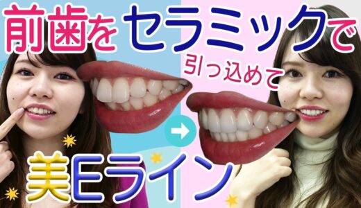 【出っ歯セラミック治療】削る→仮歯→完成まで公開★色＆形の決め方【湘南歯科クリニック大宮院・立川惇里歯科医師】大きめ前歯を内側に矯正