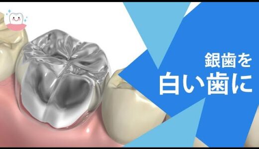 セラミッククラウンを使って白くてキレイな歯の仕上がりに!!　White Tooth With Ceramic Crown!