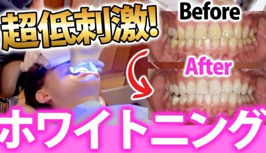 【ホワイトニング】低刺激で痛みにくい！歯医者のおすすめホワイトニング