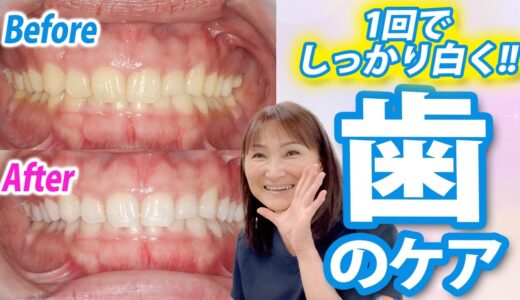 ホワイトニングは1回でどれくらい効果があるの？実際にスタッフがやってみた！