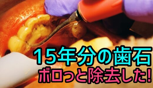 Remove Tartar! 15年分の歯石をボロっと除去しました！