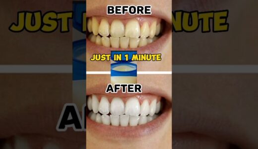 Teeth Whitening and Scaling at home without Dentist! #homeremedies #remedies #kitchenhacks #trending