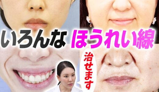 【あなたは大丈夫？】ほうれい線のタイプ別治療法お教えします！