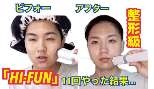 【小顔】話題の家庭用ハイフ「HI-FUN」11回やった結果…#垢抜け#小顔#ハイフン#HIFU#顔痩せ #美顔器#ハイフ#HIFUN