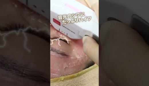 【リフトアップ】目元のシワにひたすらハイフ