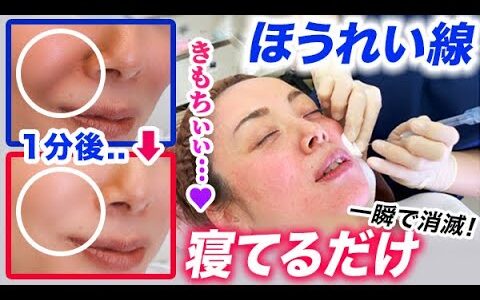 【ほうれい線】一瞬で消える！ヒアルロン酸注入で努力要らずのほうれい線解消治療すべて見せます【閲覧注意】