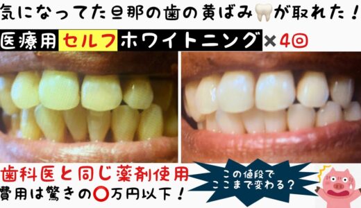 【旦那の歯が白くなった！】次世代ホワイトニング・歯科医院と同じ液剤使用！セルフだから安価でも結果が出た！！