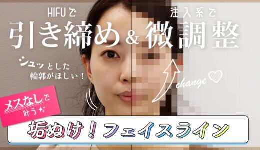 【 引き締めて微調整 】 HIFU と 注入系治療 で フェイスライン はどこまで変わる？【 HIFU ・ ヒアルロン酸 ・ ボツリヌス注射 】