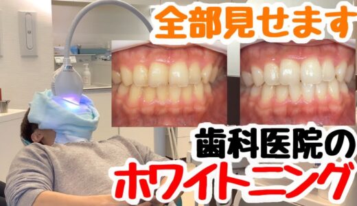 ホワイトニング　歯医者さんが実演しながら解説【歯 オフィスホワイトニング 歯科医院】