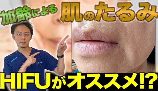 【たるみ改善】たるんだ皮膚にはHIFUがオススメ！？加齢でたるんだ頬のたるみを引き上げる方法【40〜50代必見】