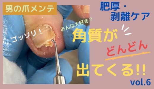 【フットケア】【footcare】爪が伸びない！！！剥離肥厚のダブルトラブル！！