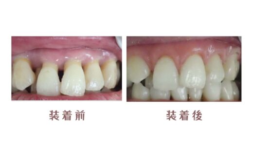 歯肉退縮どうする？？ ③　歯並びの乱れと歯周病とブラックトライアングル　口元の見た目を解決したい！美デンタルクリニック　＃前歯のスキマ　#手術無し