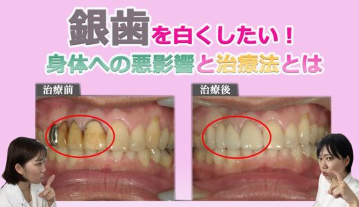 銀歯を白くしたい！身体への悪影響と治療法とは