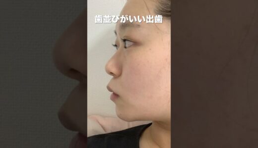 【社会人矯正】歯並びが良い口ゴボの横顔ブスが整形級に顔も声も変わりました | 垢抜けビフォーアフター #shorts  #矯正　#矯正日記