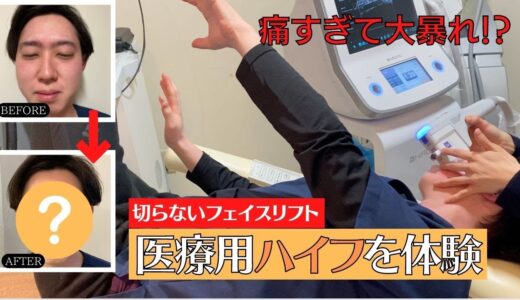 【切らないフェイスリフト】医療用ハイフをスタッフが体験してみた結果