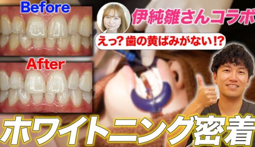 【伊純雛さんコラボ】歯の黄ばみをなくす！ホワイトニング施術に密着！