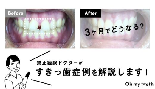 【マウスピース矯正 すきっ歯 症例】20代男性・IT系キャリアコンサルタント【歯科医師が解説】