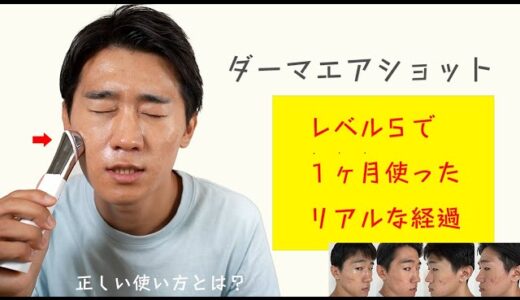 【１ヶ月】ダーマエアショットを毎日レベル５で使ってみたリアルな効果・・・正しい使い方を知らないと損します。