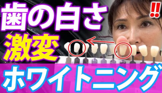 【ホワイトニング 歯医者 おすすめ】歯医者さん激推し！最新ホワイトニングでどれくらい白くなるか検証！