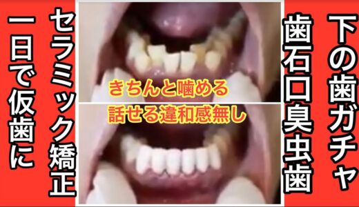 下の前歯　がちゃがちゃをセラミック矯正の仮歯で即日改善