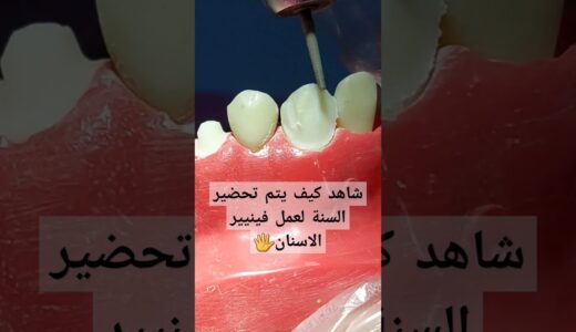 #فينيير #الاسنان #تجميل #اسناني