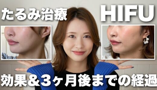 【美容医療】HIFU (ハイフ)の効果と経過をレポします！