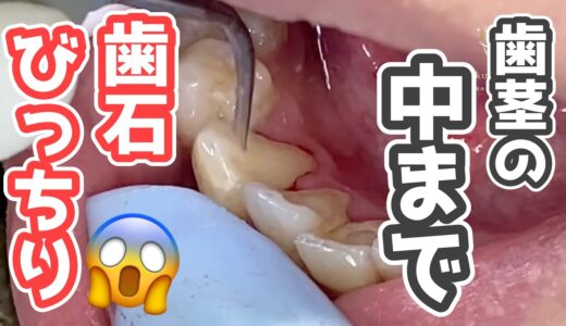 【閲覧注意】歯茎の内側まで歯石がびっちり😱！歯の形がわからない😱！【歯石除去】