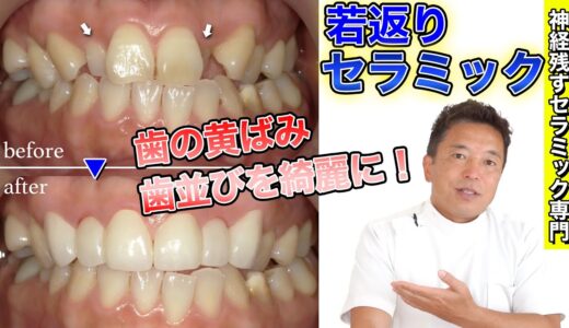 【40代若返りセラミック】 歯の黄ばみと歯並び症例【神経を残すセラミック治療】