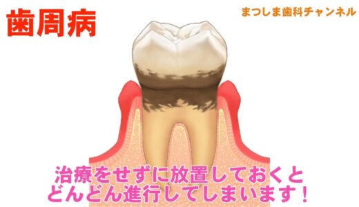 【広島市佐伯区 歯医者】あなたの歯周病、進行していませんか？_まつしま歯科チャンネル016（口腔ケアチャンネル）