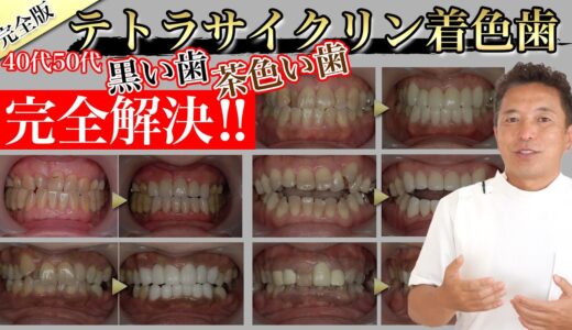 40代50代｜歯が黒い、歯が茶色いことで悩んでい方必見！【テトラサイクリン着色歯特集】